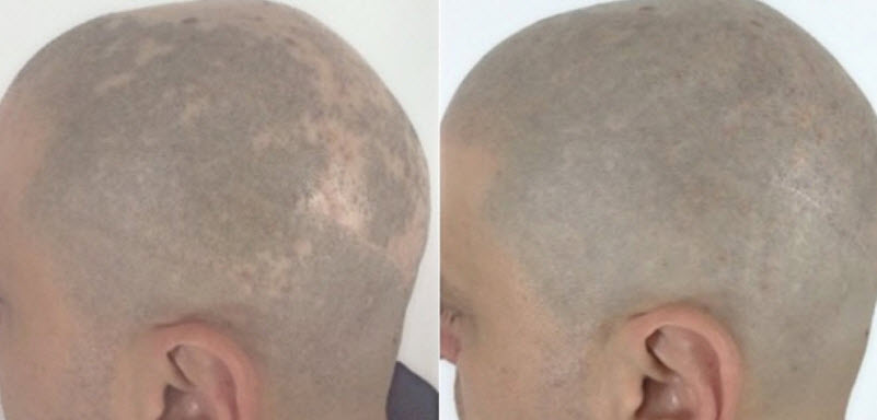 Male Alopecia