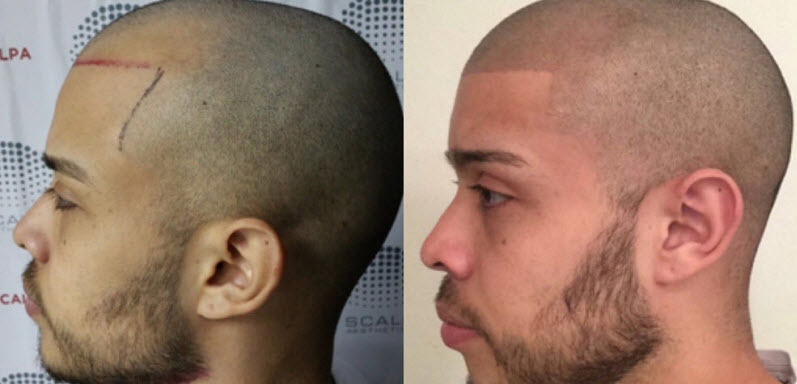 Hair and Scalp Pigmentation Before and After Pictures and Images